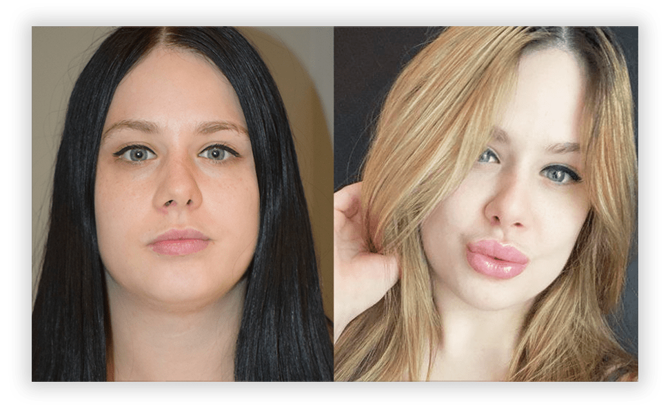 Before And After Non Surgical Cosmetic Treatments Greater Toronto Area Lip Doctor 